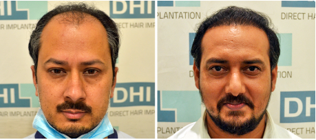best hair transplant clinic in delhi